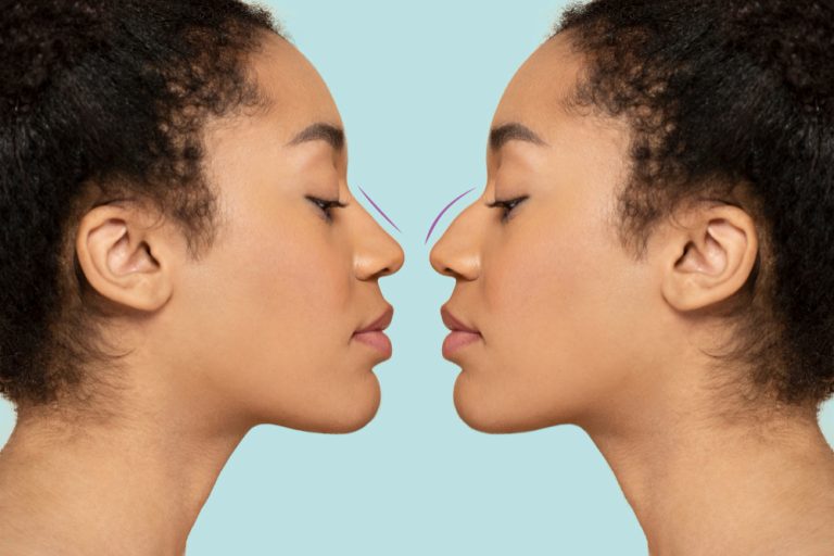 Rhinoplasty consultation