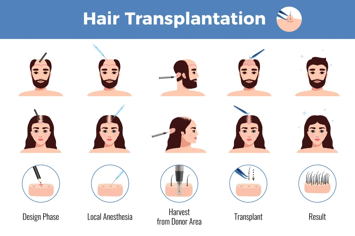 Hair transplant planning