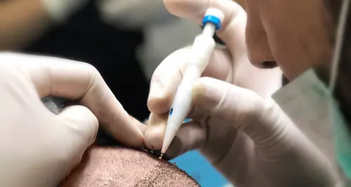 DHI Hair Transplant