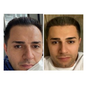 Before after result