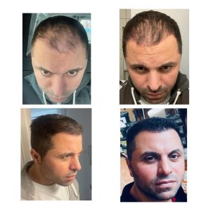 Before after result