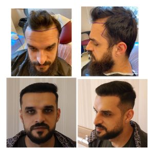 Before after result