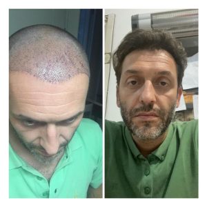 Before after result