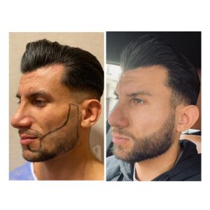 Before after result
