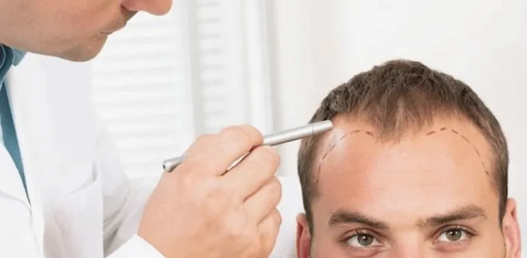 FUE Hair Transplant