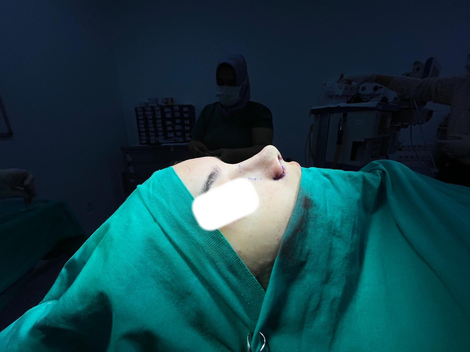 After rhinoplasty