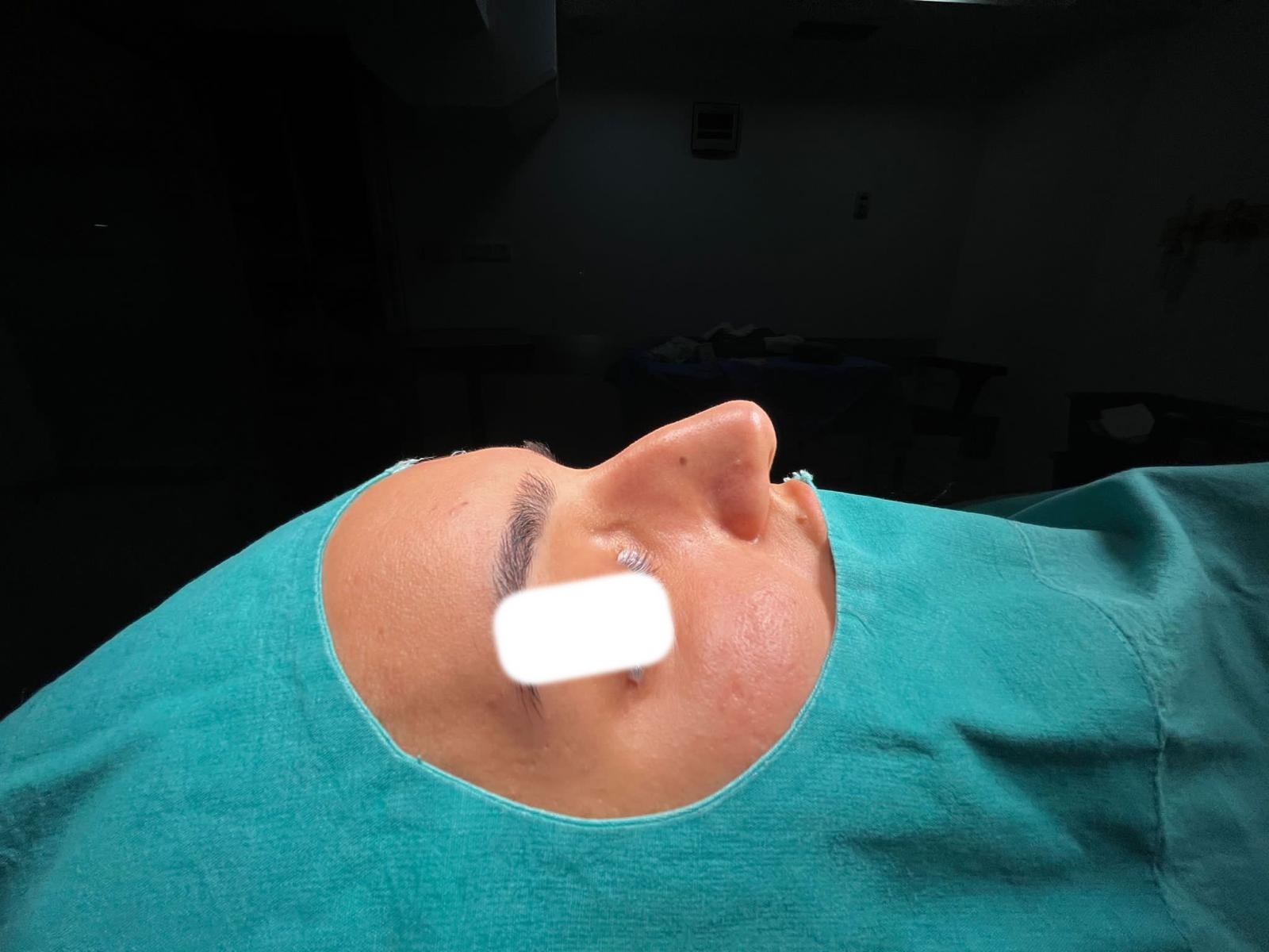 Before rhinoplasty
