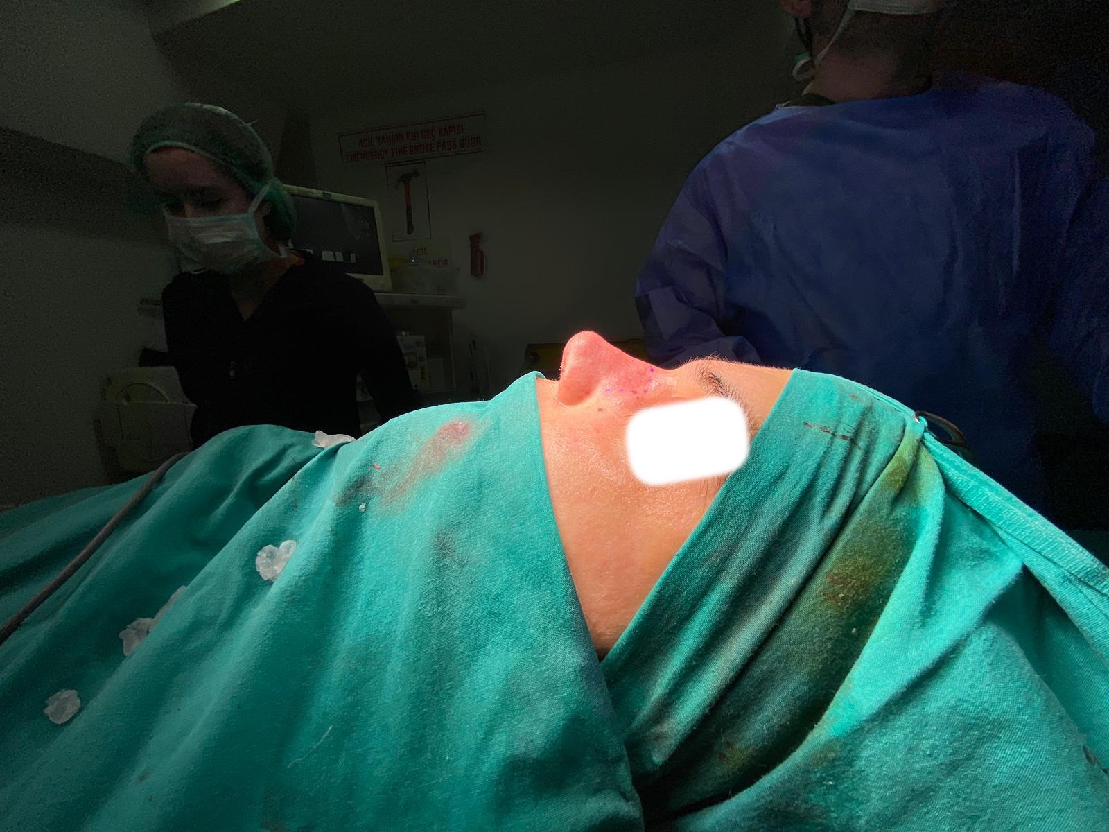 After rhinoplasty