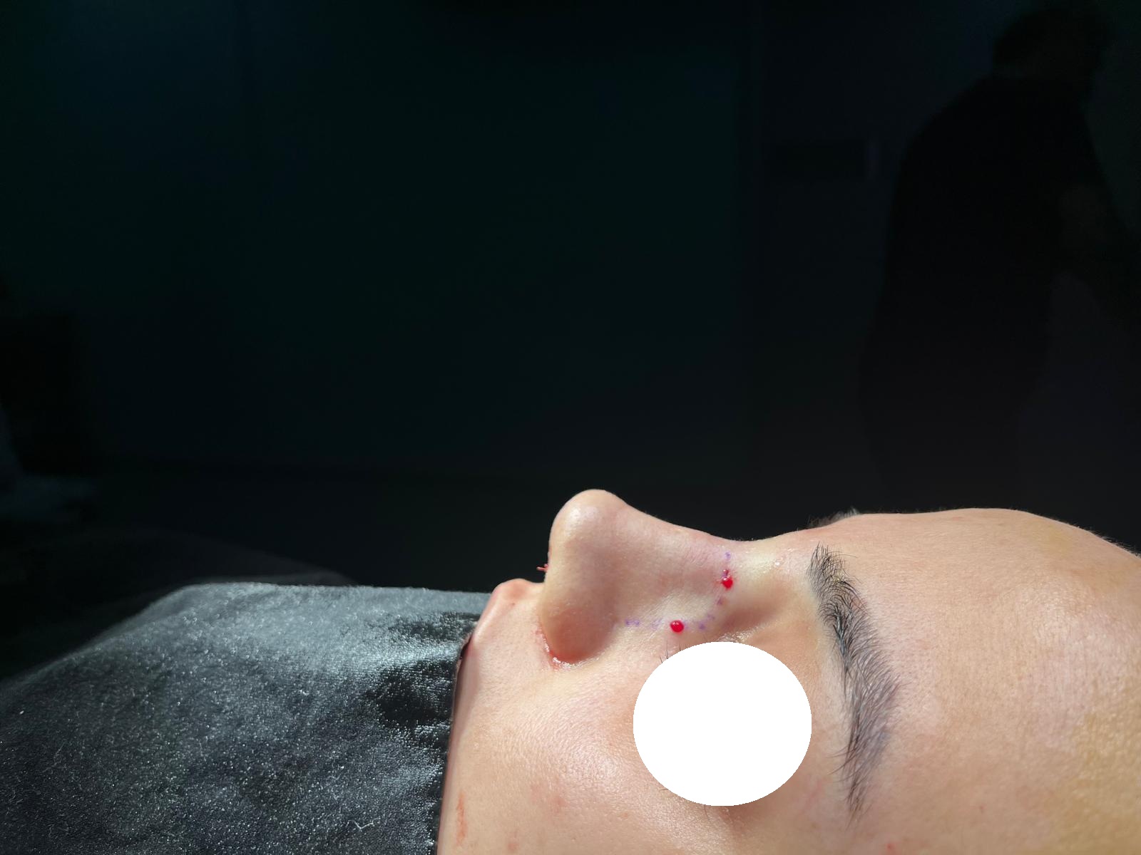 After rhinoplasty